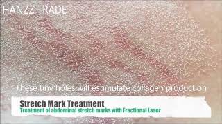 Laser Treatment for Stretch Marks [upl. by Leiria]