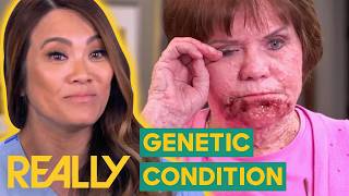 Neurofibromatosis Treated By Dr Sandra Lee Changes Patients Life  Dr Pimple Popper [upl. by Gotthelf]