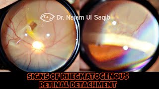 Clinical Signs Of Rhegmatogenous Retinal Detachment [upl. by Latsyrc]