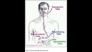 Jejunostomy Feeding Tube [upl. by Fidelas]