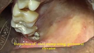 Root stump removal using periosteal elevator [upl. by Leunas893]