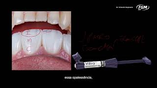 DicasDeConsultório Estratificação em resina composta com Vittra APS [upl. by Langley144]