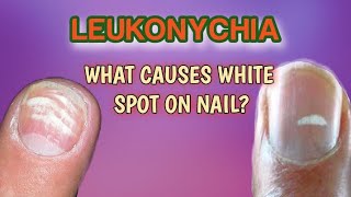 Leukonychia  what are white spot on nail [upl. by Andrel862]