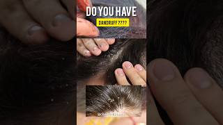 ❌️Dont use this Remedy for Dandruff 😱😳Shocking results😱 shorts hair dandruff winter diy [upl. by Norra]