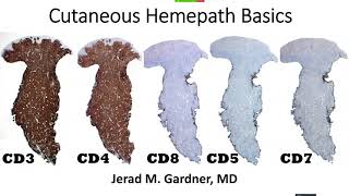 Cutaneous Hemepath 101 Skin Lymphoma Leukemia amp Histiocytic Infiltrate Basics Hematopathology [upl. by Mufi551]