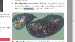 Surgery bezoar trichobezoar eating hair Trichophagy PAPAIN Cellulase Enzyme Lavage Fragmentation [upl. by Yelats378]