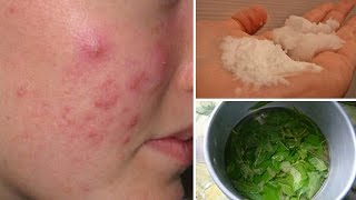 7 Cystic Acne Home Remedies that Really Work [upl. by Adnic]