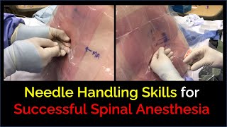 Successful Spinal Anesthesia  Skillful Needle Handling [upl. by Odnumyer]