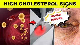 These Signs Tell You That You Have High Blood Cholesterol Warning Signs Of High Blood Cholesterol [upl. by Khoury]