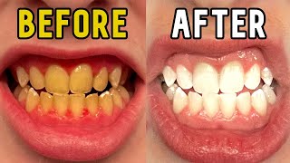 How I Whitened My Teeth in 14 Days [upl. by Romaine]