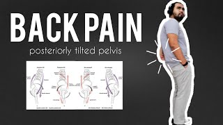 back pain amp sway back posture [upl. by Dennet]