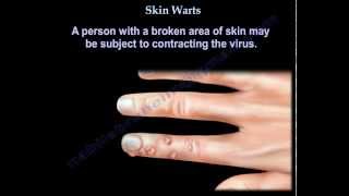 Skin Warts  Hand warts  Everything You Need To Know  Dr Nabil Ebraheim [upl. by Dnomasor]