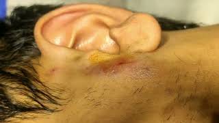 Preauricular abscess drainage without Incision No IncisionDr D K Gupta [upl. by Annehs]