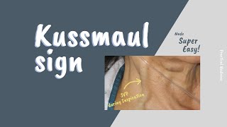 Kussmaul sign SIMPLIFIED FOR CLEAR UNDERSTANDING [upl. by Diann]