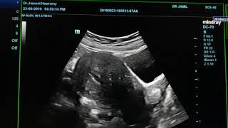 Adenomyosis Ultrasound [upl. by Novets]