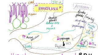 Ménètriers disease Pathophysiology [upl. by Bastien882]