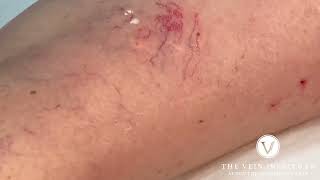 Sclerotherapy Procedure Spider Vein Treatment [upl. by Laurene]