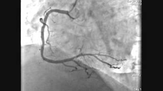 LMCA Stenting Acute MI [upl. by Maclaine]