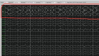 Temporal Lobe Seizure in Sleep [upl. by Liban976]