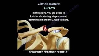 Clavicle Fractures  Everything You Need To Know  Dr Nabil Ebraheim [upl. by Aelahs]