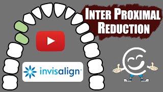 Inter Proximal Reduction IPR For Invisalign Treatments [upl. by Hollington]