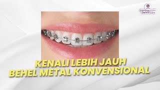 APASIH BEHEL METAL KONVENSIONAL ITU [upl. by Ahsitak]