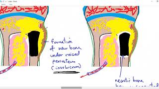 Systemic pathology 34  bone 4  osteomyelitis  DRSAMEH GHAZY [upl. by Enimrej]