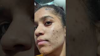 Tretinoin cream 0025 before and after 1 YEAR OF TRETINOIN tretinoin shortsfeed tretinoincream [upl. by Yusem]