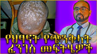 የህፃናት የጭንቅላት ፈንገስ መፍትሄዎች  Dr Fasil [upl. by Aserat]