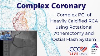 Complex PCI Heavily Calcified RCA using Rotational Atherectomy amp Ostial Flash System Oct 2014 Video [upl. by Gensler412]