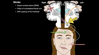 Bells Palsy and Stroke [upl. by Meikah]