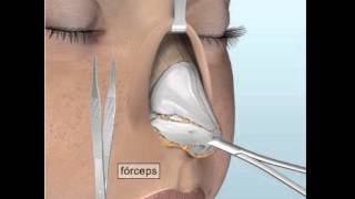 Rinoplastia abierta [upl. by Ardehs]