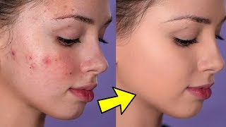 How To Cover Acne and Blemishes  EASY amp NONCAKEY [upl. by Taro]