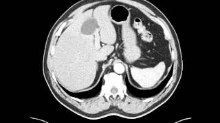 Esophageal leiomyoma distal esophagus  CT [upl. by Irita]