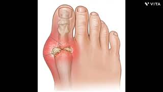 gouty arthritis and rheumatoid arthritis  osteoarthritis amp rheumatoid arthritis [upl. by Mabel979]