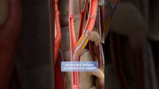 How carotid stenting prevents stroke a stepbystep guide to restoring blood flow [upl. by Vincents888]