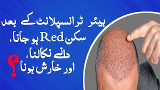 After Hair Transplant Skin Redness Acnes and Itching  Dr Habib Ullah Shah [upl. by Adnahsal606]