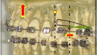 BURSTONE  ARCOS SEGMENTADOS PARA INTRUSÃO COM CONTROLE DE TORQUE [upl. by Lednek]