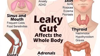 6 Steps to Heal Leaky Gut and Autoimmune Disease Naturally  Health Vlogger [upl. by Silenay]