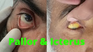 PALLOR and ICTERUS in EYE  ANEMIA and JAUNDICE in eye examination [upl. by Troy]