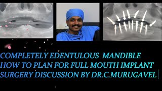 Completely edentulous mandible  how to plan for full mouth implant surgery [upl. by Kazue141]