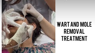 Wart removal treatment shortsvideo wart youtubeshort viralvideos trending aesthetic [upl. by Cristabel]