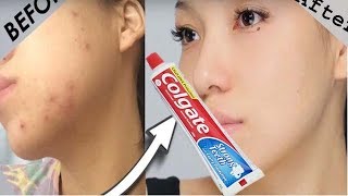 Quick Face whitening with Toothpaste Rang Gora Toothpaste Face Mask Remove PimplesDark spots [upl. by Aloz834]