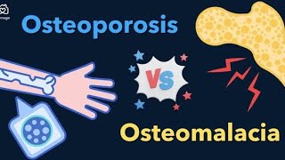 Difference Between Osteoporosis and Osteomalacia [upl. by Haldis467]