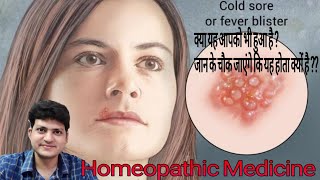 Homeopathic Medicine for fever blister  Cold sores  Herpes labialis [upl. by Lleznol]