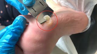 Callus removal from feetampFoot scraping dead skin【Xiao Yan pedicure】stress 1109 [upl. by Rosette553]