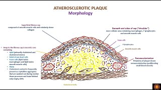 atherosclerosis morphology and consequences [upl. by Stephannie]