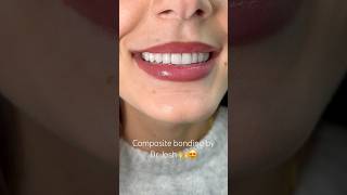 Composite bonding by Dr Josh 🙌 dentalbonding smilemakeover [upl. by Htebaile]