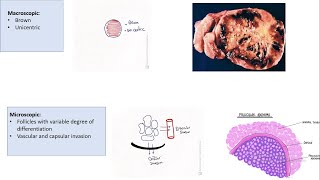 Thyroid Follicular carcinoma  Etiology  Presentation Mico and Macroscopic picture” [upl. by Leasim606]