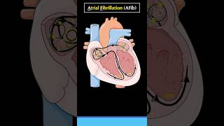 What is Atrial Fibrillation AF or AFib atrialfibrillation cardiology arrhythmia heart [upl. by Judenberg67]